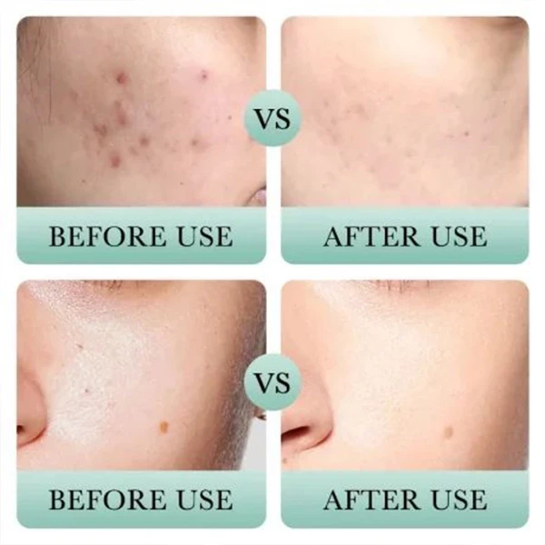 High Nourishing Deep Cleansing Pores Skin Care Improvement Salicylic Acid Facial