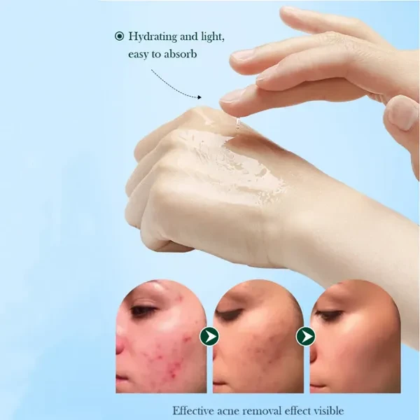 Sadoer Acnes Tea Tree Skin Care Deeping Clean Moisturizes Hydrating Oil Control