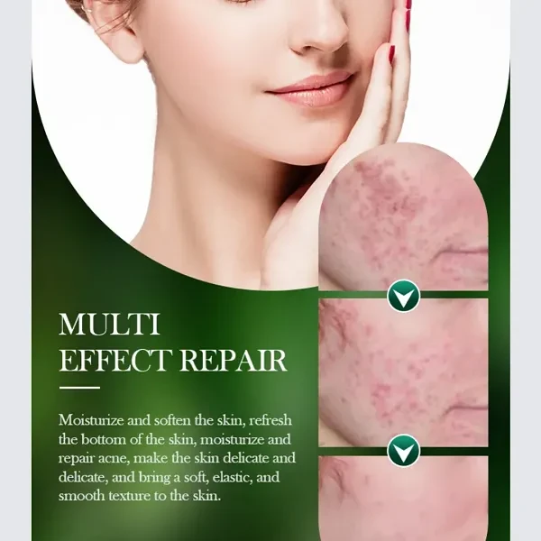 Sadoer Acnes Tea Tree Skin Care Deeping Clean Moisturizes Hydrating Oil Control