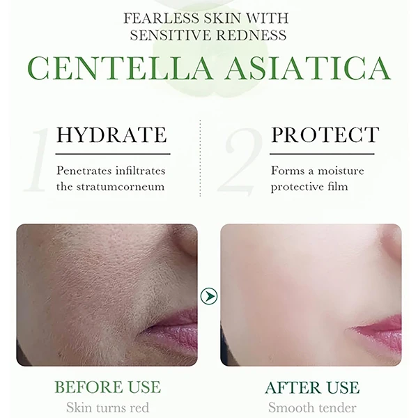 Centella Asiatica Anti-Acne Oil Control Personal Care Nourish Skin Repair Face C