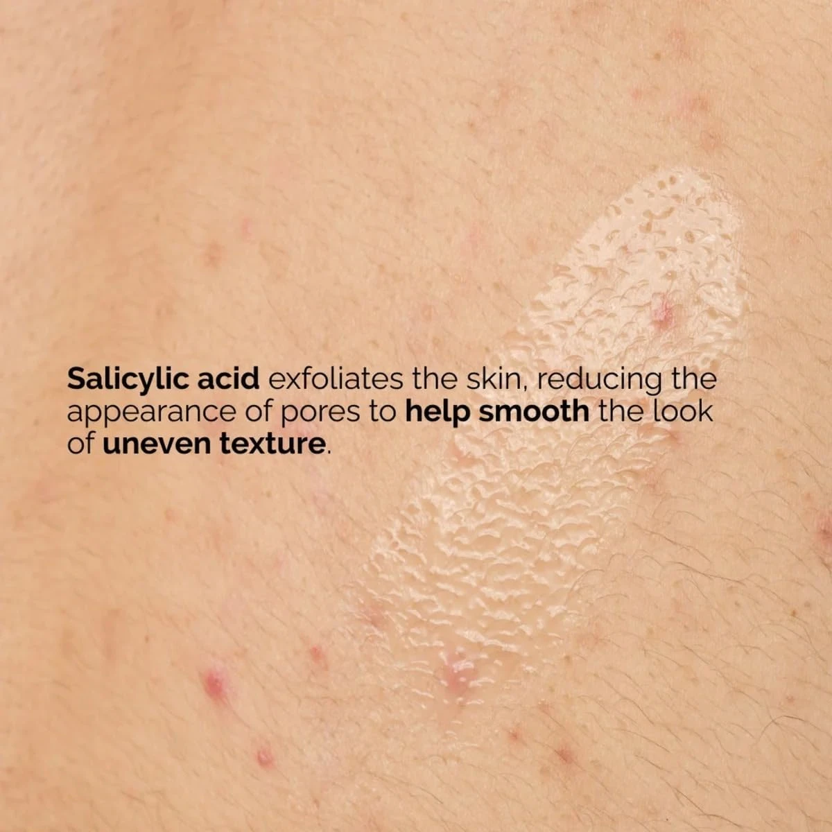 The Ordinary Salicylic Acid 0.5% Body Serum (240ml) – Exfoliating Treatment for 