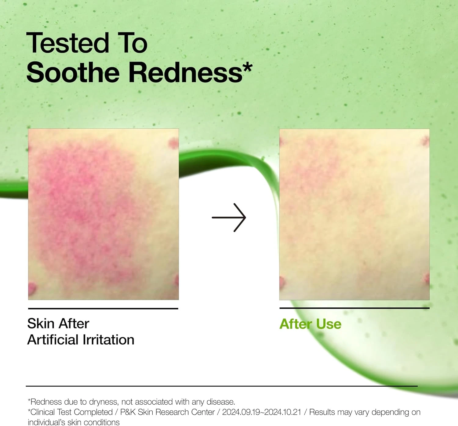 Anua Azelaic Acid 10 Hyaluron Redness Soothing Serum, Facial Serum for Sensitive