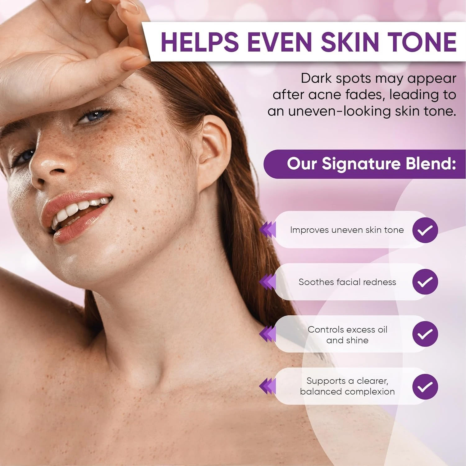 Nigwedete丨14% Azelaic Acid Acne Cream丨Advanced Azelaic Acid Serum丨Redness Relief