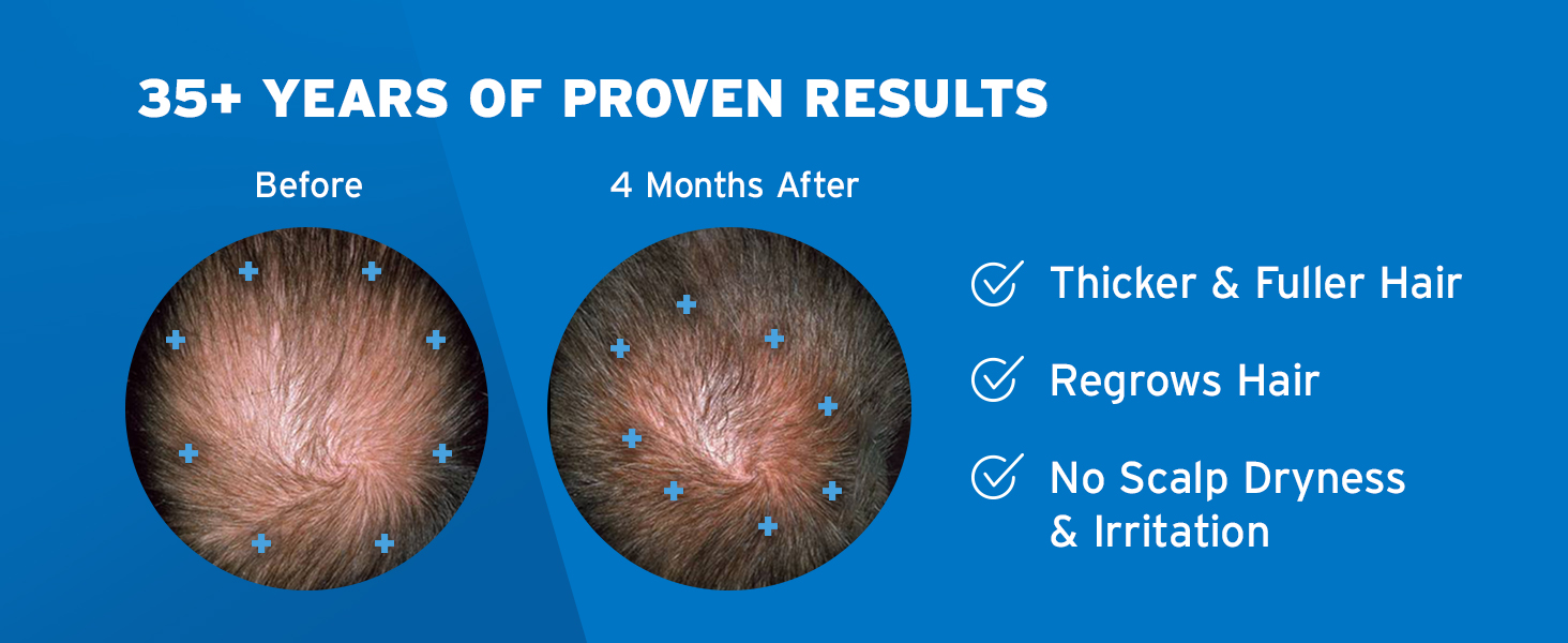 Men's Rogaine Extra Strength 5% Minoxidil Topical Solution for Thin Hair banner 4