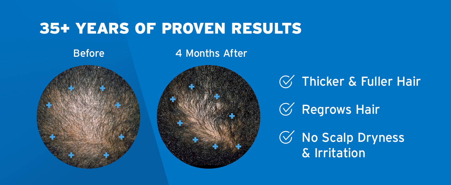 Men's Rogaine Extra Strength 5% Minoxidil Topical Solution for Thin Hair banner 3
