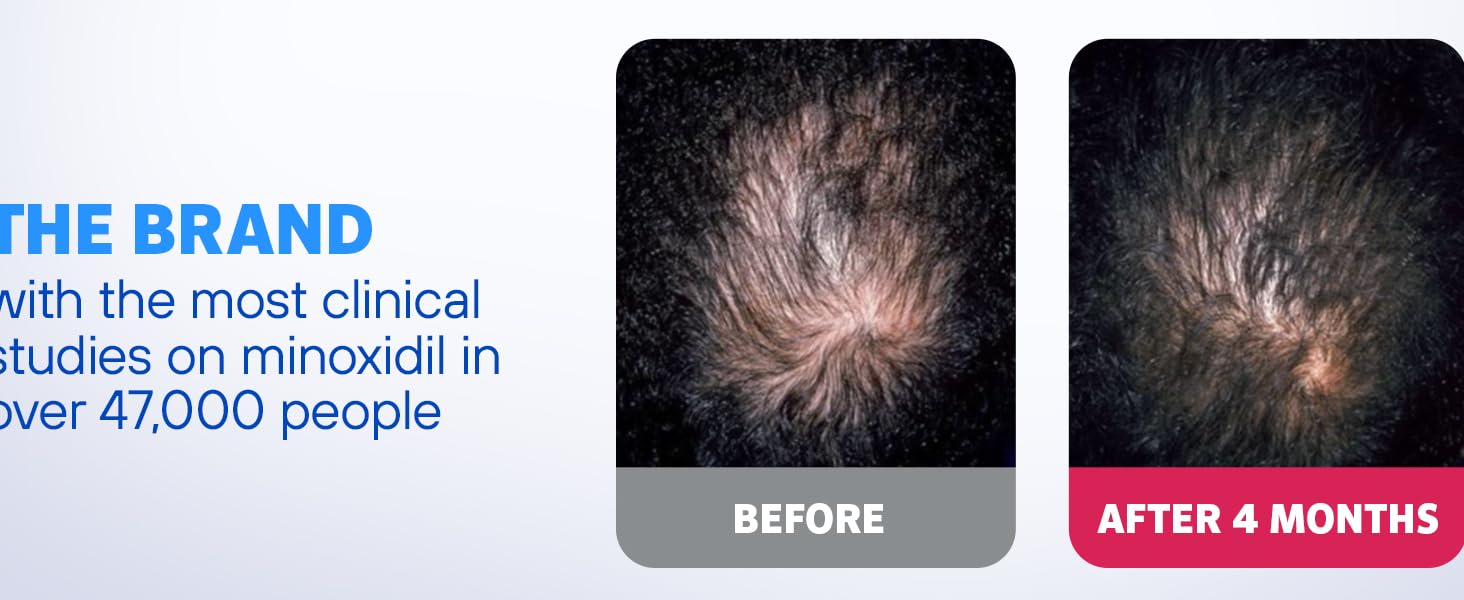 Men’s Rogaine Extra Strength 5% Minoxidil Topical Solution for Hair Loss and Hai banner 4