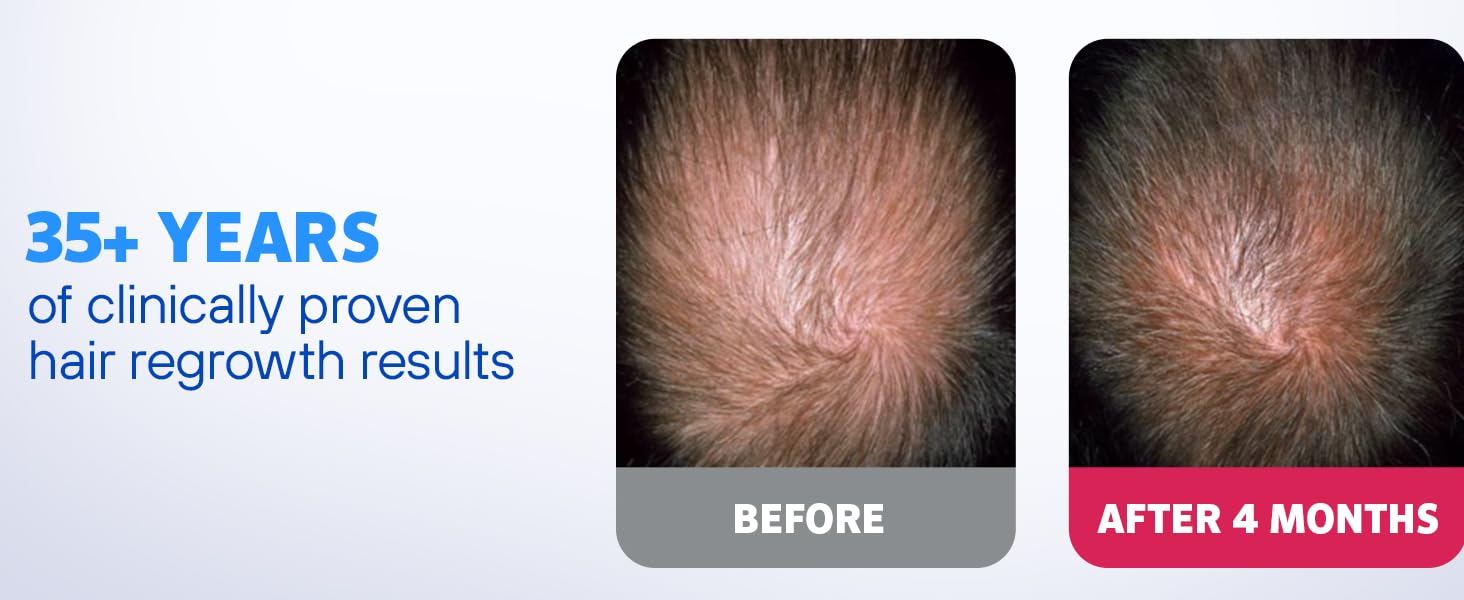 Men’s Rogaine Extra Strength 5% Minoxidil Topical Solution for Hair Loss and Hai banner 5