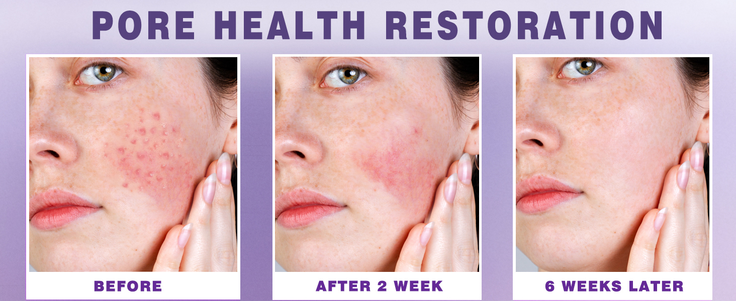 Nigwedete丨14% Azelaic Acid Acne Cream丨Advanced Azelaic Acid Serum丨Redness Relief banner 3